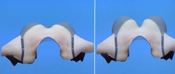 3d-Vectra-Breast-Augmentation