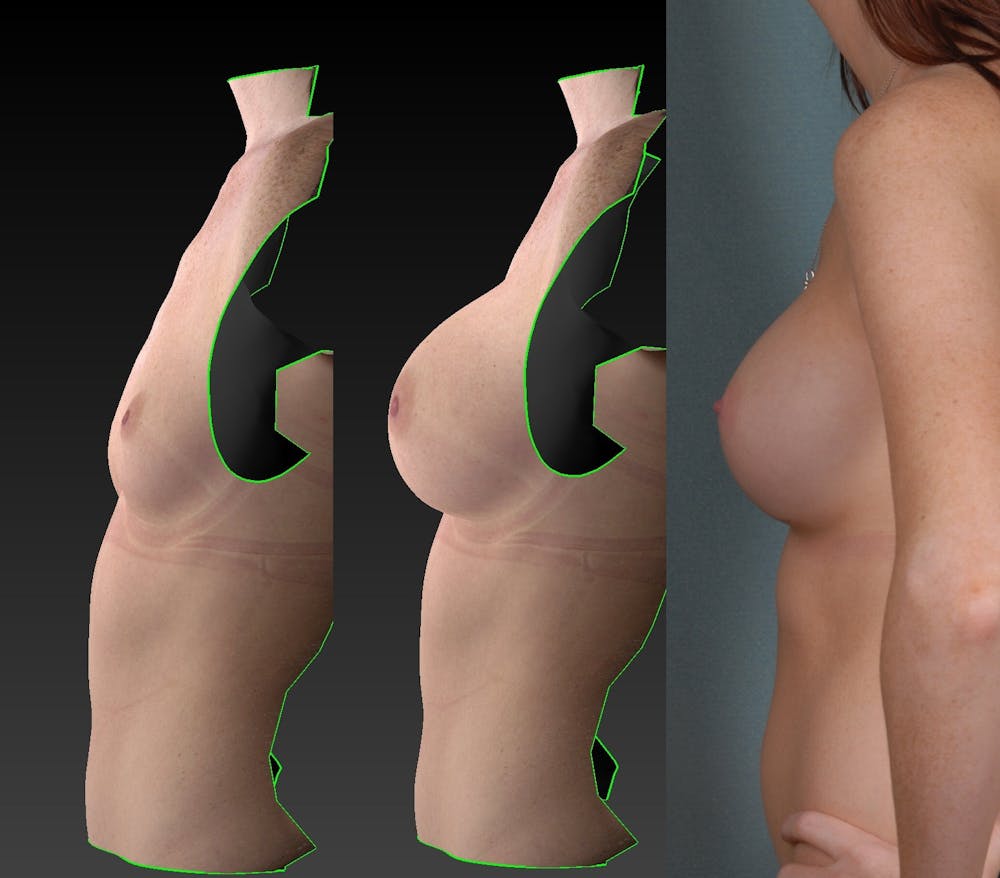 Denver-breast-implant-result-photos