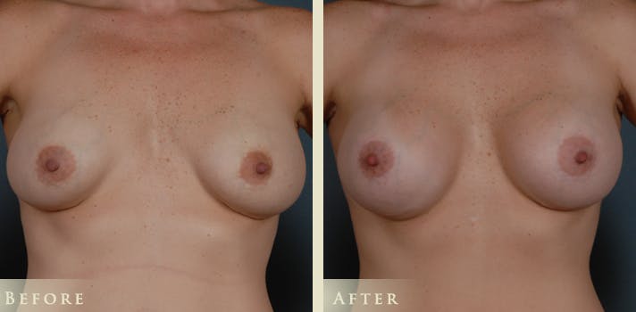 Breast Implant Revision Surgery Denver, Colorado
