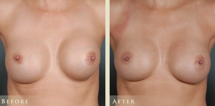 Capsular Contracture Revision Surgery Denver, Colorado