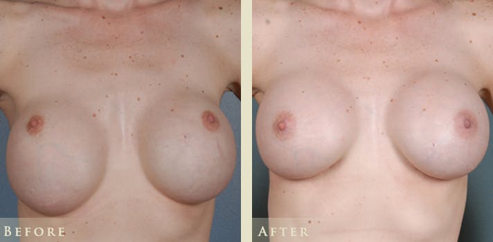 Bottoming Out Breast Implant Revision Denver, Colorado