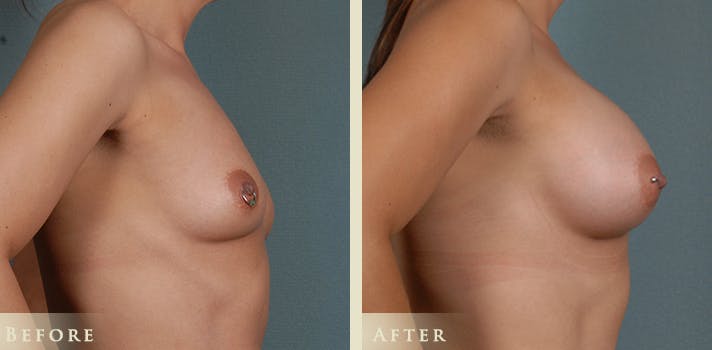 Denver Breast Augmentation patient with 410 silicone implants