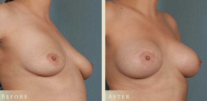 410 Silicone Implant Before and After Photo Denver, Colorado