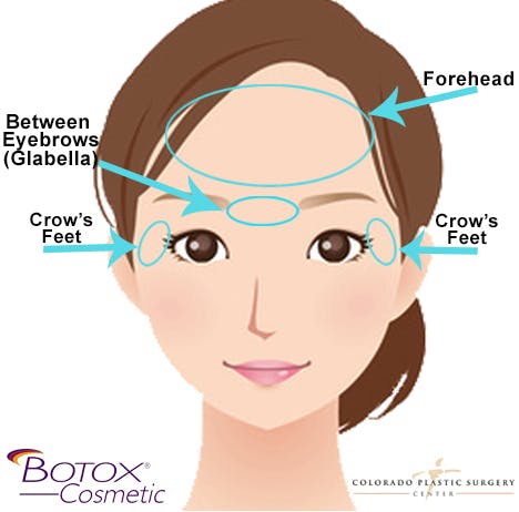 botox infographic