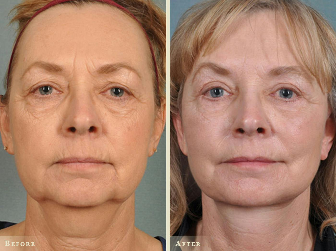 Facelift Before & After Gallery - Patient 327266 - Image 1