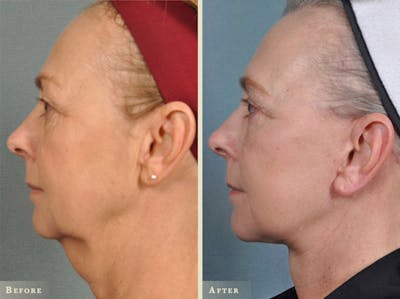 Facelift Before & After Gallery - Patient 327266 - Image 2