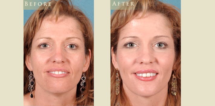 Facelift Before & After Gallery - Patient 217319 - Image 1