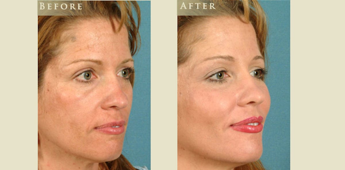 Facelift Before & After Gallery - Patient 217319 - Image 2