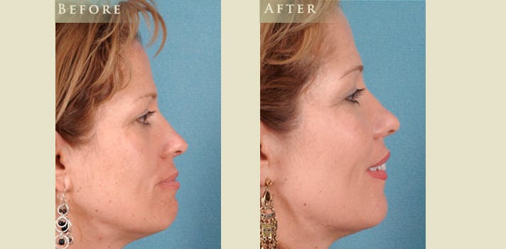 Facelift Before & After Gallery - Patient 217319 - Image 3