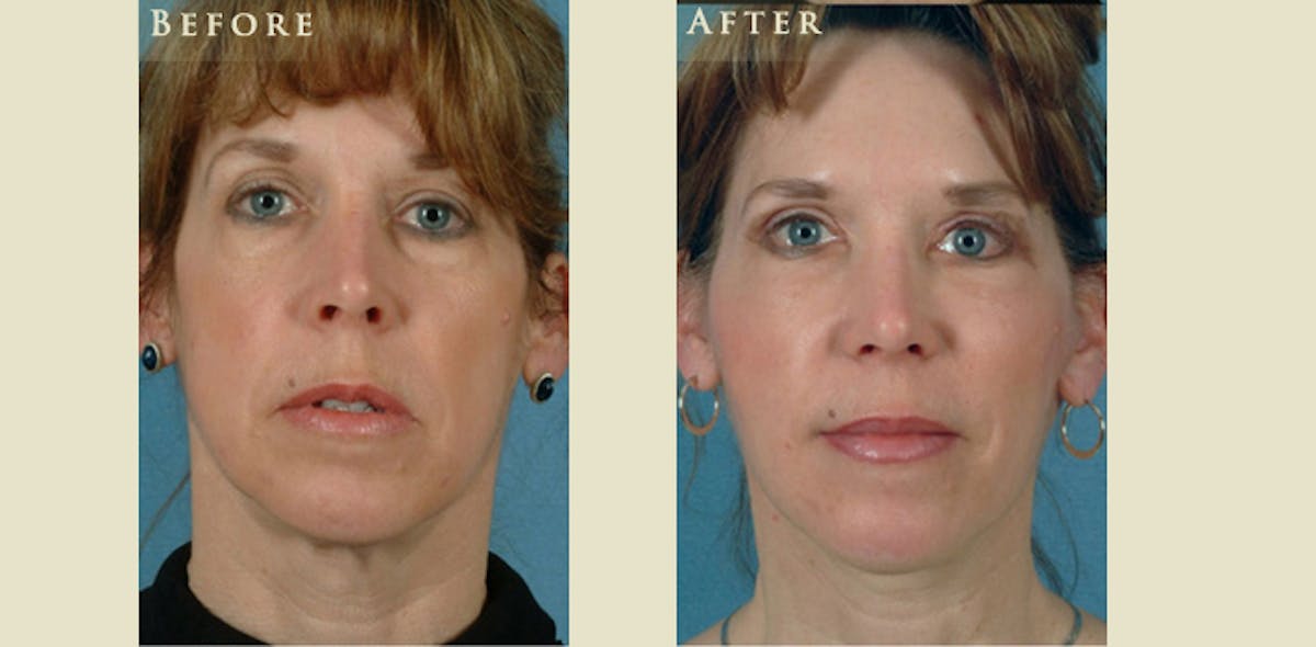 Facelift Before & After Gallery - Patient 158542 - Image 1
