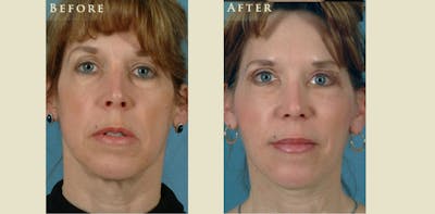 Facelift Before & After Gallery - Patient 158542 - Image 1