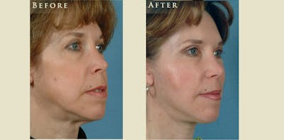 Facelift Before & After Gallery - Patient 158542 - Image 2