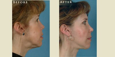 Facelift Before & After Gallery - Patient 158542 - Image 3
