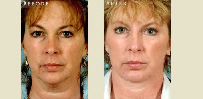 Facelift Before & After Gallery - Patient 375209 - Image 1