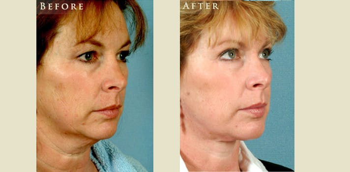 Facelift Before & After Gallery - Patient 375209 - Image 2