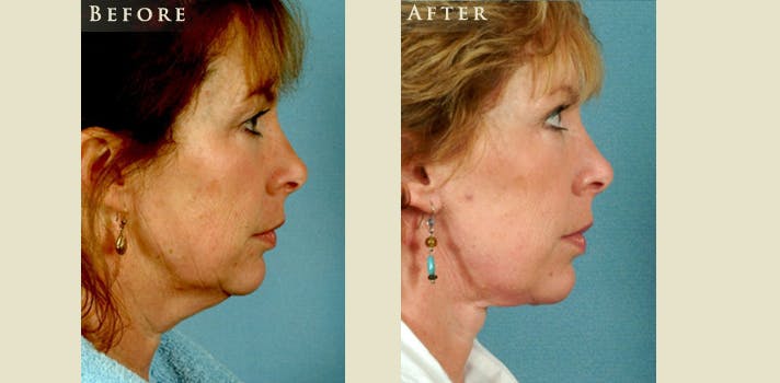 Facelift Before & After Gallery - Patient 375209 - Image 3