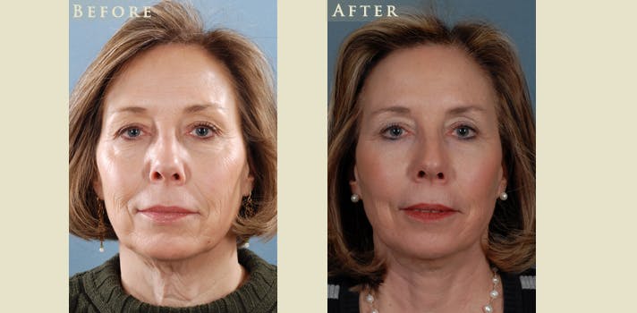 Facelift Before & After Gallery - Patient 909720 - Image 1