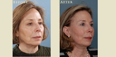 Facelift Before & After Gallery - Patient 909720 - Image 2