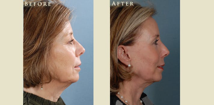 Facelift Before & After Gallery - Patient 909720 - Image 3