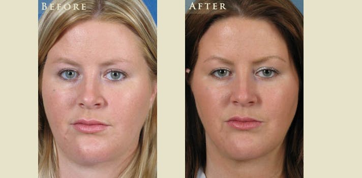 Facelift Before & After Gallery - Patient 422298 - Image 1