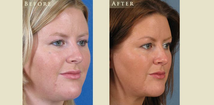 Facelift Before & After Gallery - Patient 422298 - Image 2