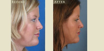Facelift Before & After Gallery - Patient 422298 - Image 3