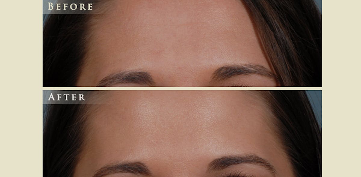 Botox® and Fillers Before & After Gallery - Patient 211167 - Image 1