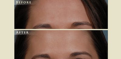 Botox® and Fillers Before & After Gallery - Patient 211167 - Image 1