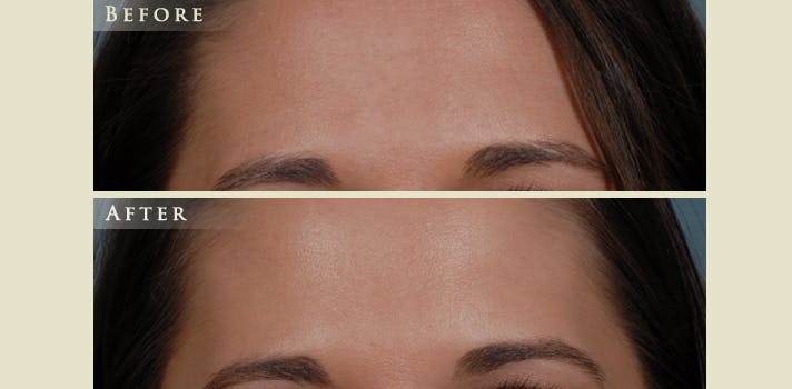 Botox® and Fillers Before & After Gallery - Patient 211167 - Image 1