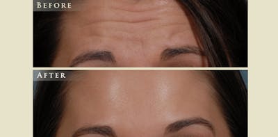 Botox® and Fillers Before & After Gallery - Patient 211167 - Image 2
