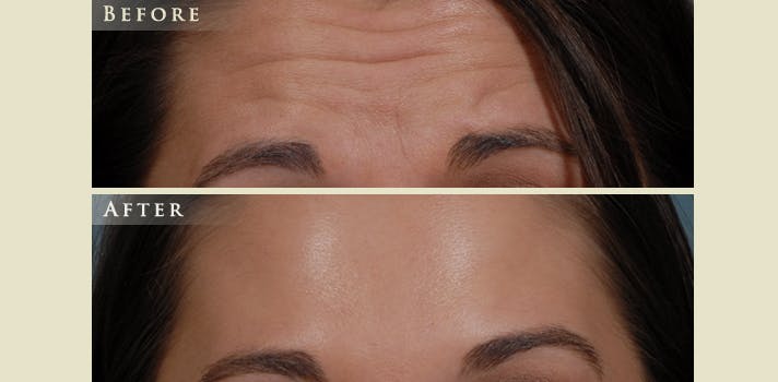 Botox® and Fillers Before & After Gallery - Patient 211167 - Image 2