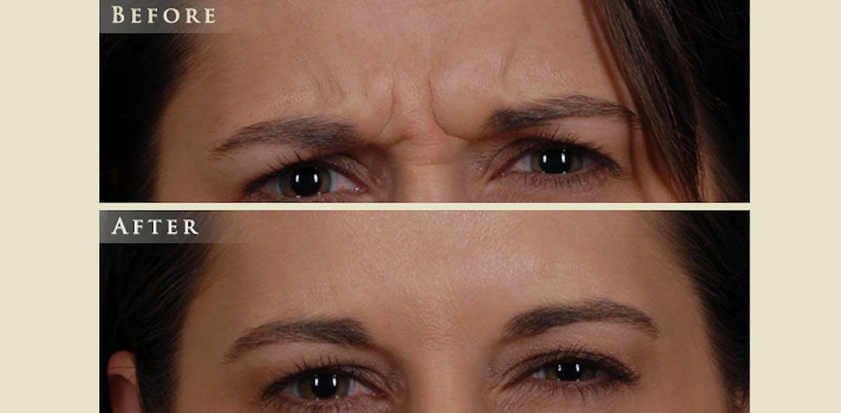 Botox® and Fillers Before & After Gallery - Patient 211167 - Image 3