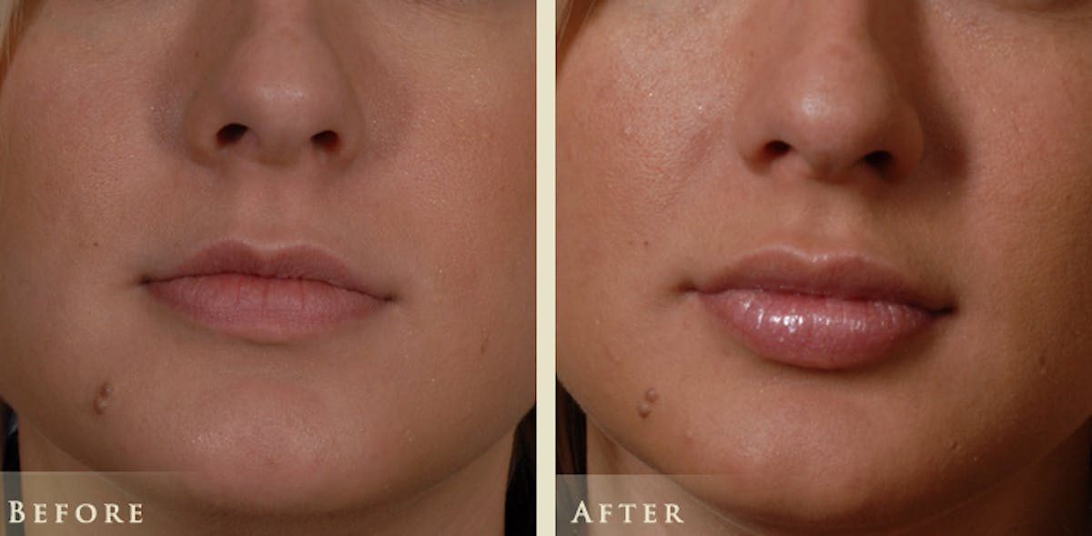 Lip Augmentation Before & After Gallery - Patient 268489 - Image 1