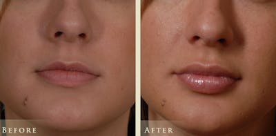 Botox® and Fillers Before & After Gallery - Patient 302708 - Image 1