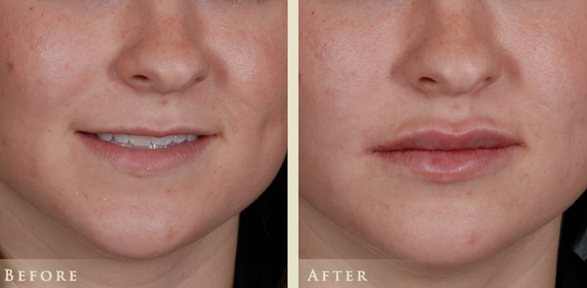 Lip Augmentation Before & After Gallery - Patient 203810 - Image 1