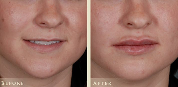 Lip Augmentation Before & After Gallery - Patient 203810 - Image 1