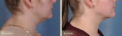 Neck Liposuction Before & After Gallery - Patient 178482 - Image 1