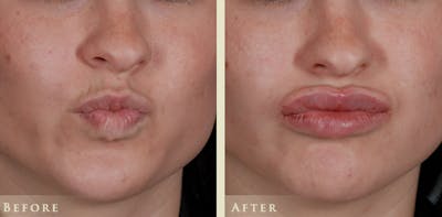Botox® and Fillers Before & After Gallery - Patient 279339 - Image 2