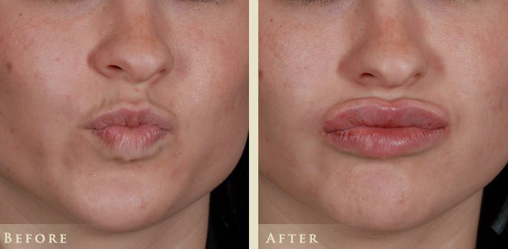 Lip Augmentation Before & After Gallery - Patient 203810 - Image 2