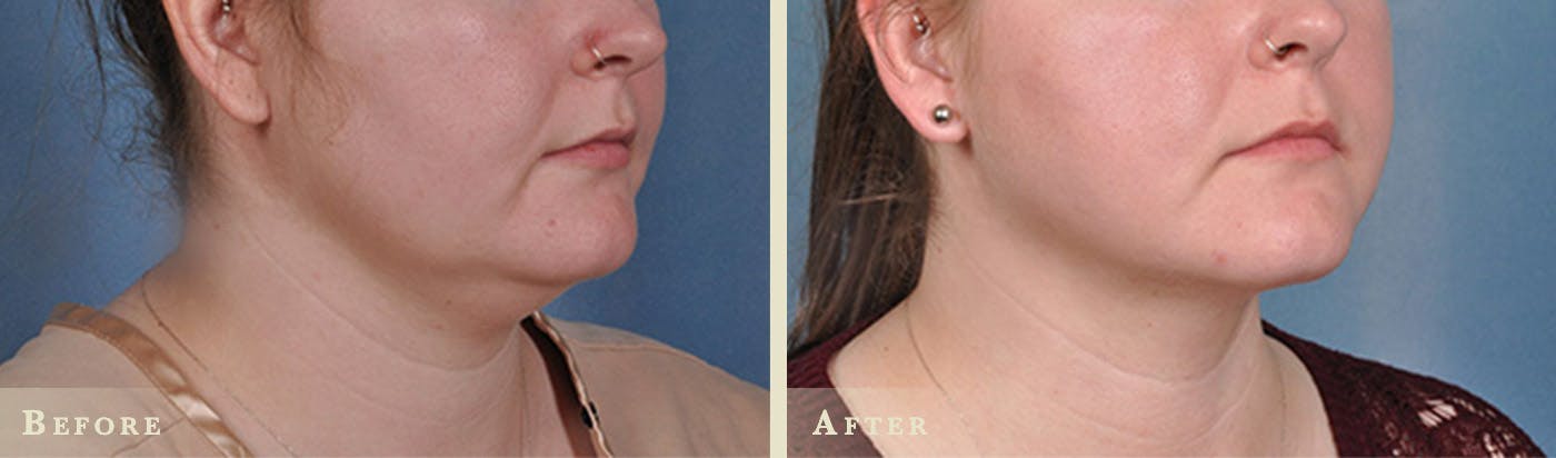 Neck Liposuction Before & After Gallery - Patient 178482 - Image 2