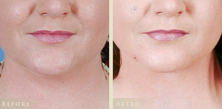 Neck Liposuction Before & After Gallery - Patient 433700 - Image 1