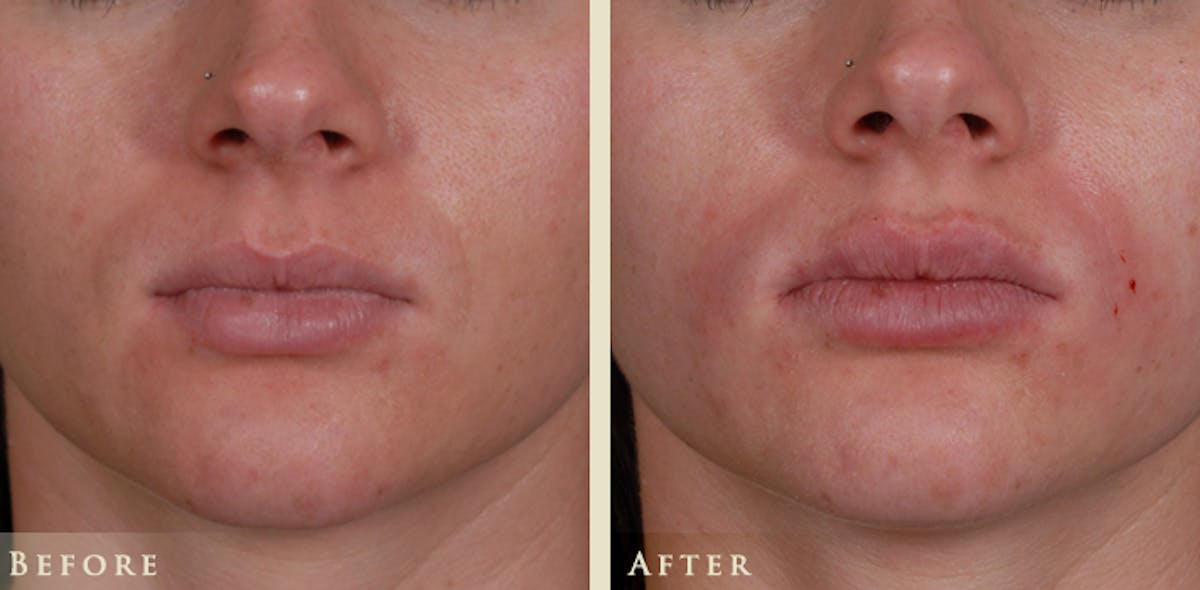 Lip Augmentation Before & After Gallery - Patient 392100 - Image 1