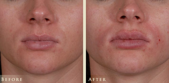 Botox® and Fillers Before & After Gallery - Patient 476325 - Image 1