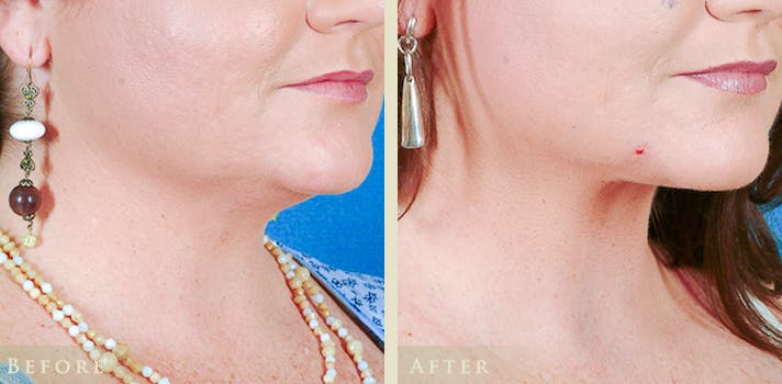 Neck Liposuction Before & After Gallery - Patient 433700 - Image 2