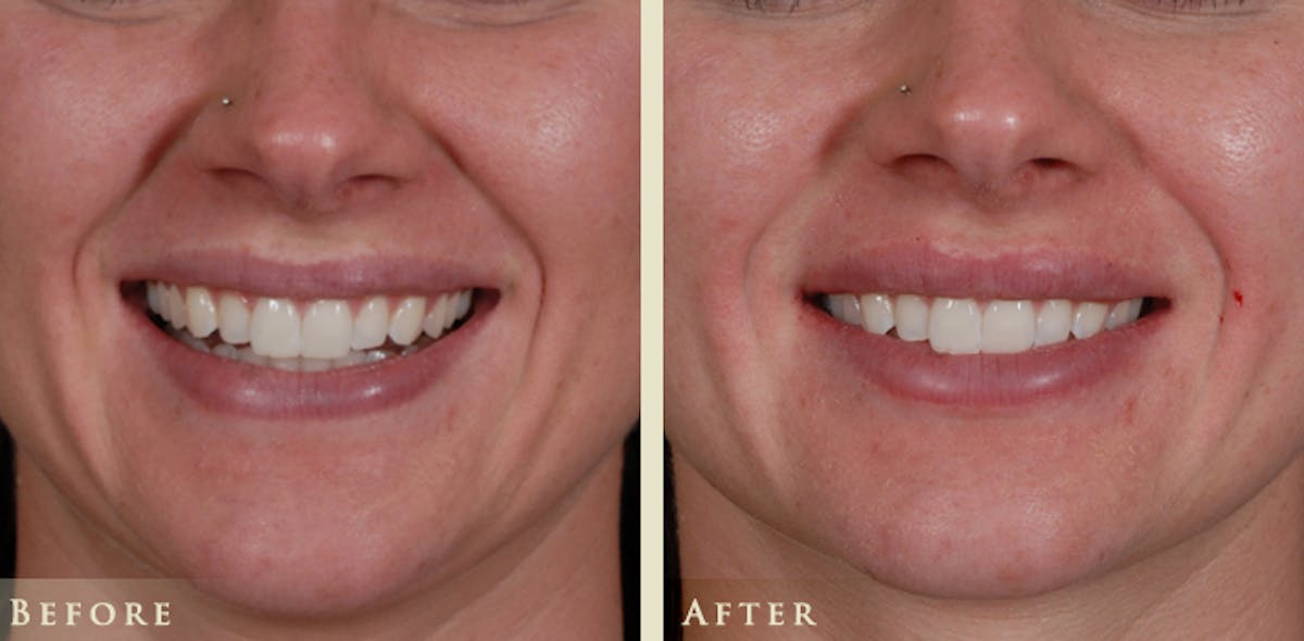 Lip Augmentation Before & After Gallery - Patient 392100 - Image 2