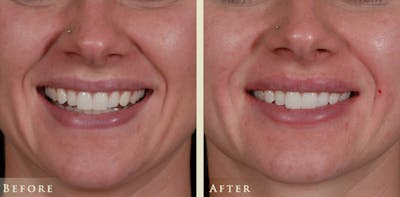 Botox® and Fillers Before & After Gallery - Patient 476325 - Image 2