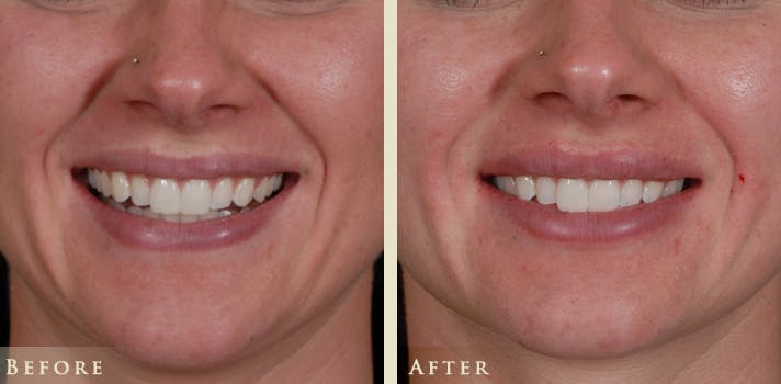 Botox® and Fillers Before & After Gallery - Patient 476325 - Image 2