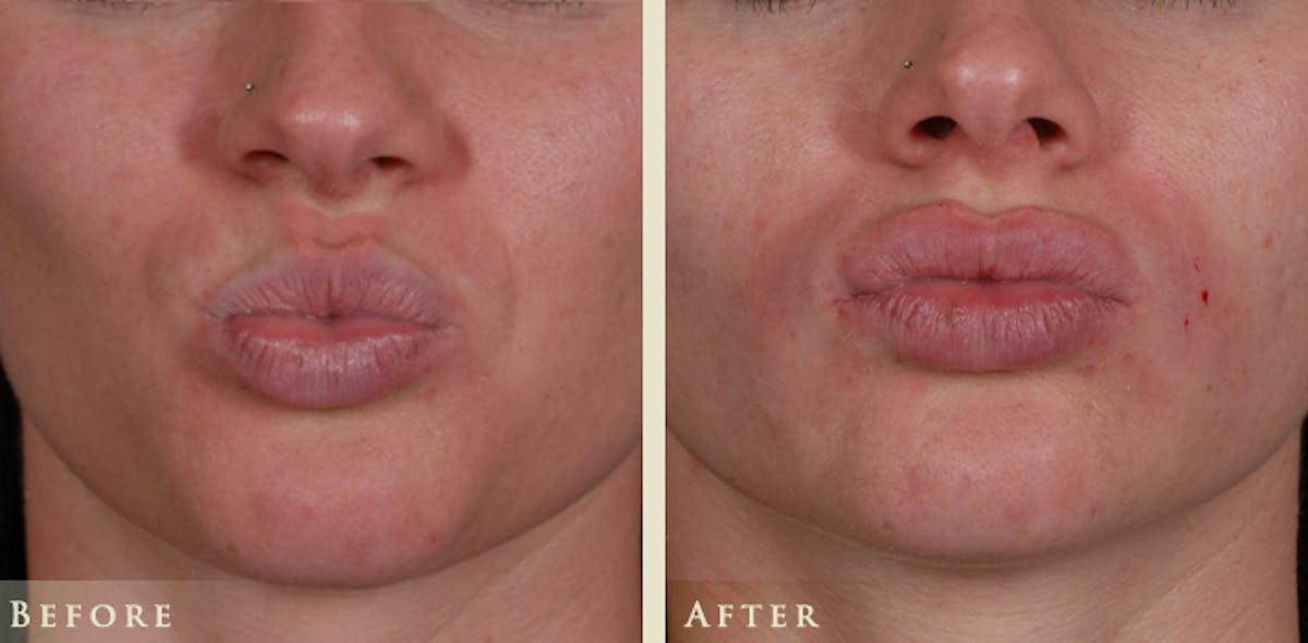 Lip Augmentation Before & After Gallery - Patient 392100 - Image 3