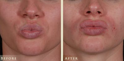Botox® and Fillers Before & After Gallery - Patient 476325 - Image 3