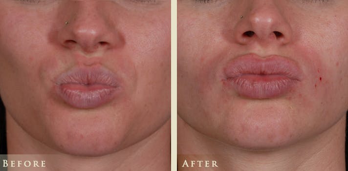 Botox® and Fillers Before & After Gallery - Patient 476325 - Image 3